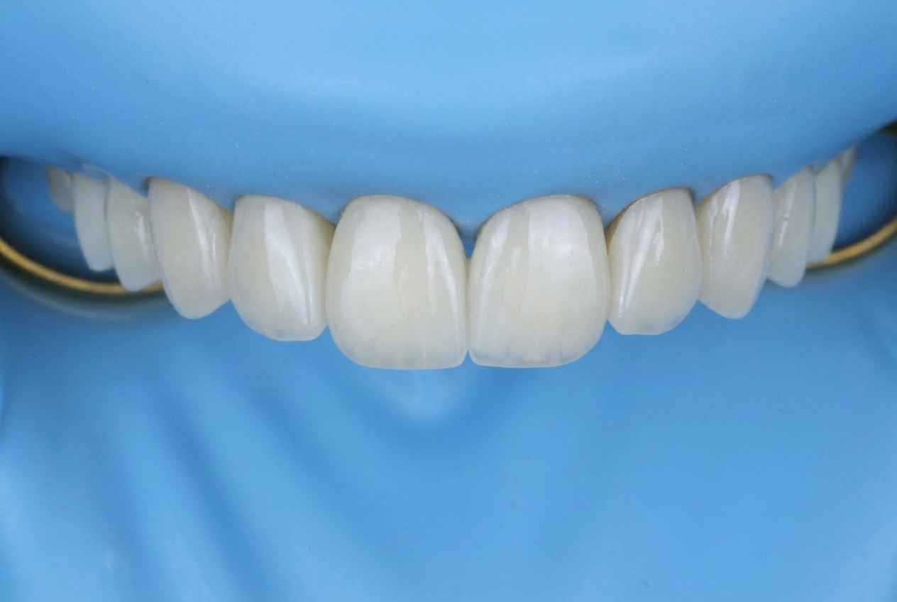 فينير خزفي — نتيجة ابتسامة هوليوود، Dental Home Clinic بغداد